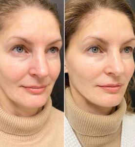 Organic Beauty - Infuzja tlenowa DermaOxy